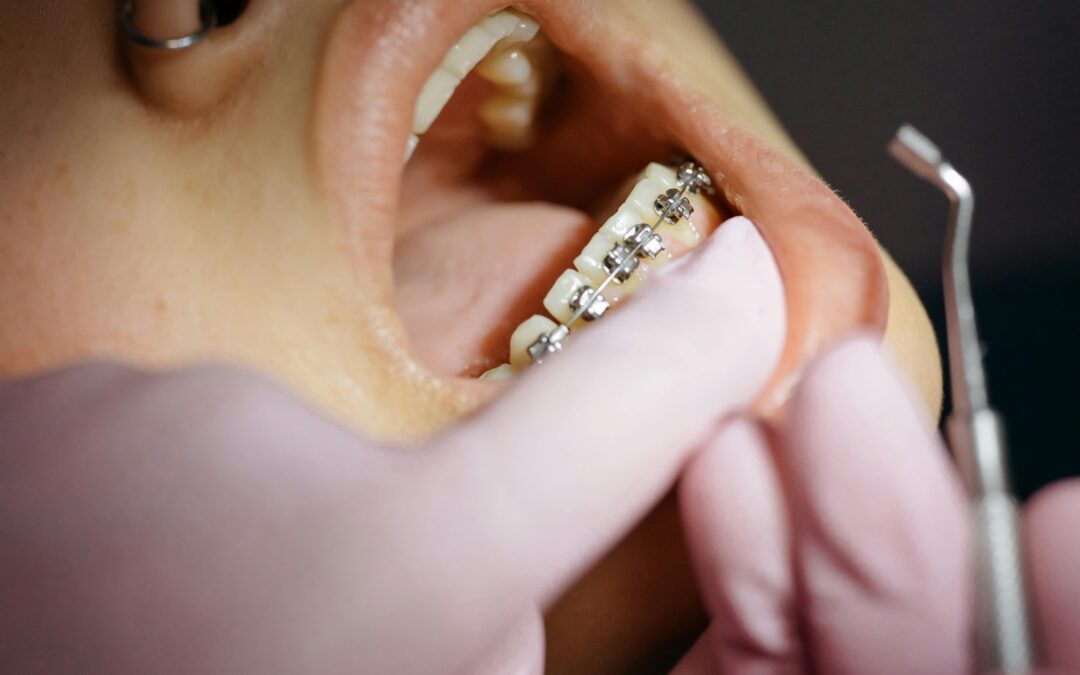 Traditional Metal Braces vs Ceramic Braces