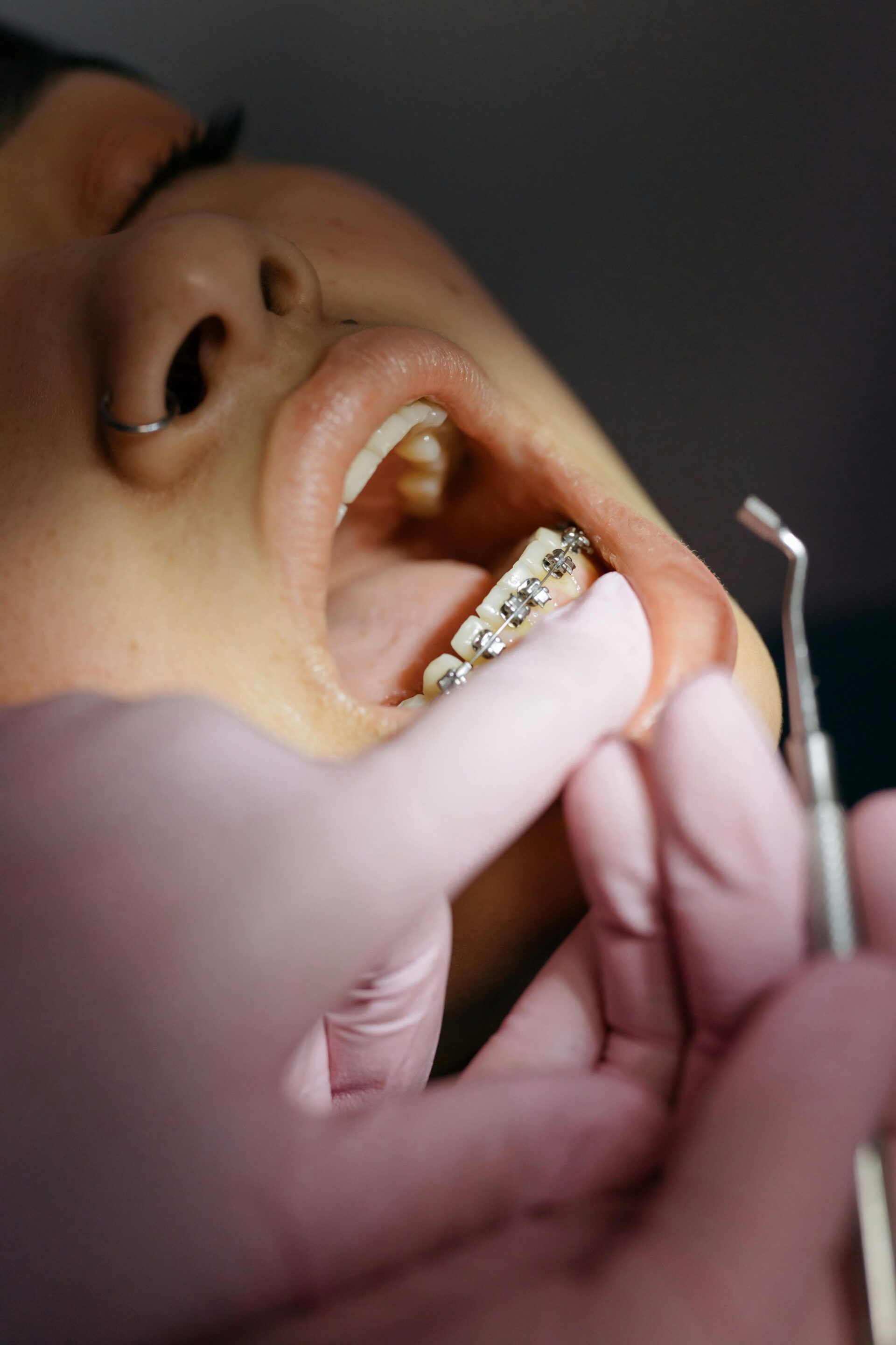 Traditional Metal Braces vs Ceramic Braces
