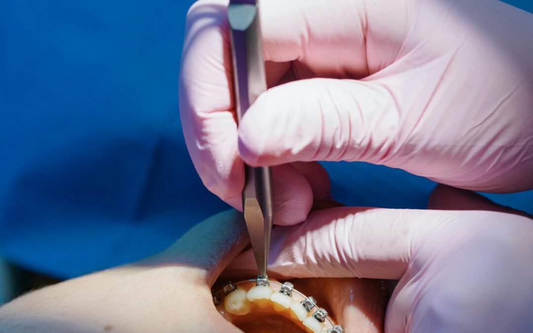 How Do Braces Work? A Plain-English Explanation
