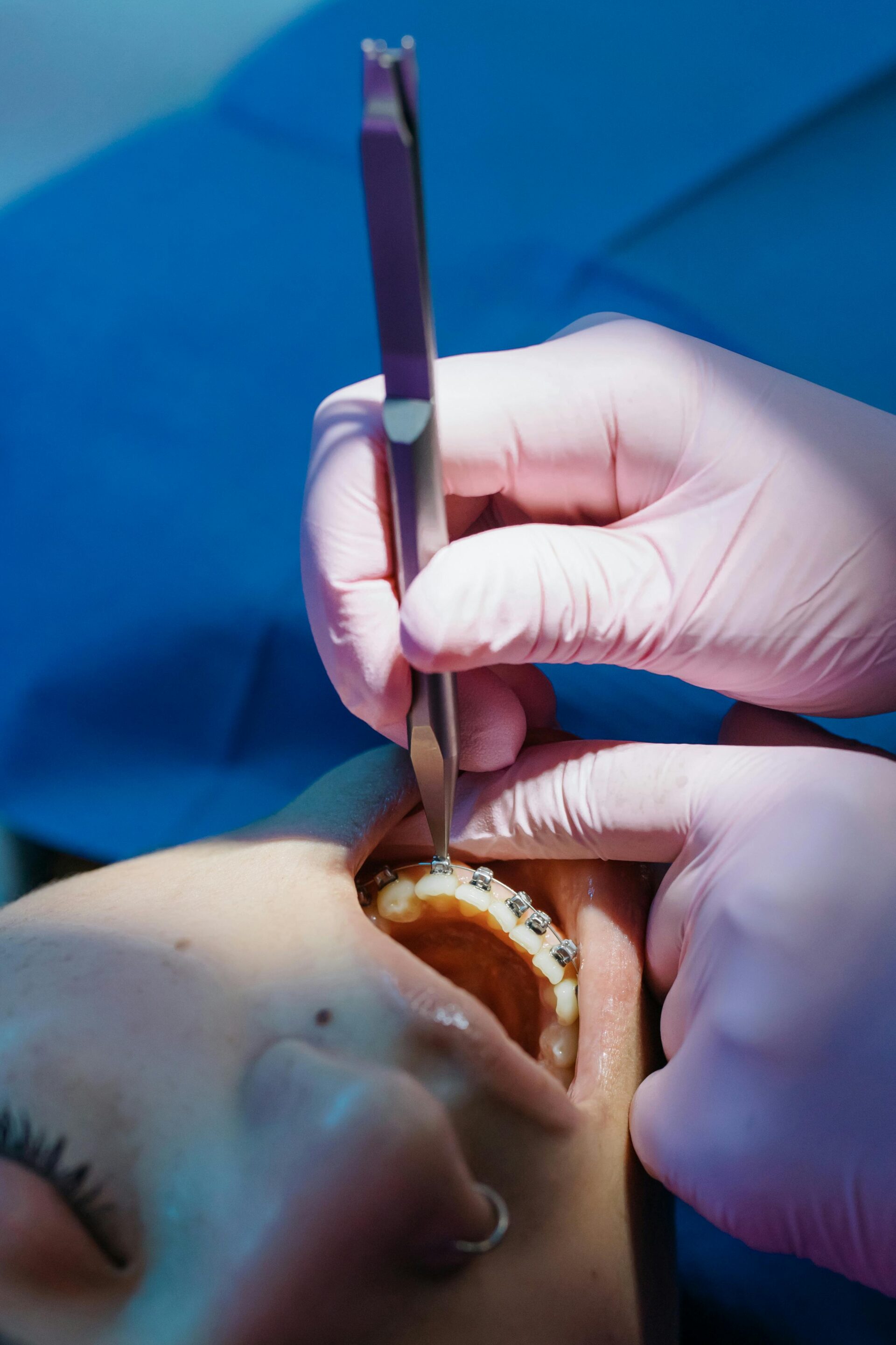 How Do Braces Work? A Plain-English Explanation