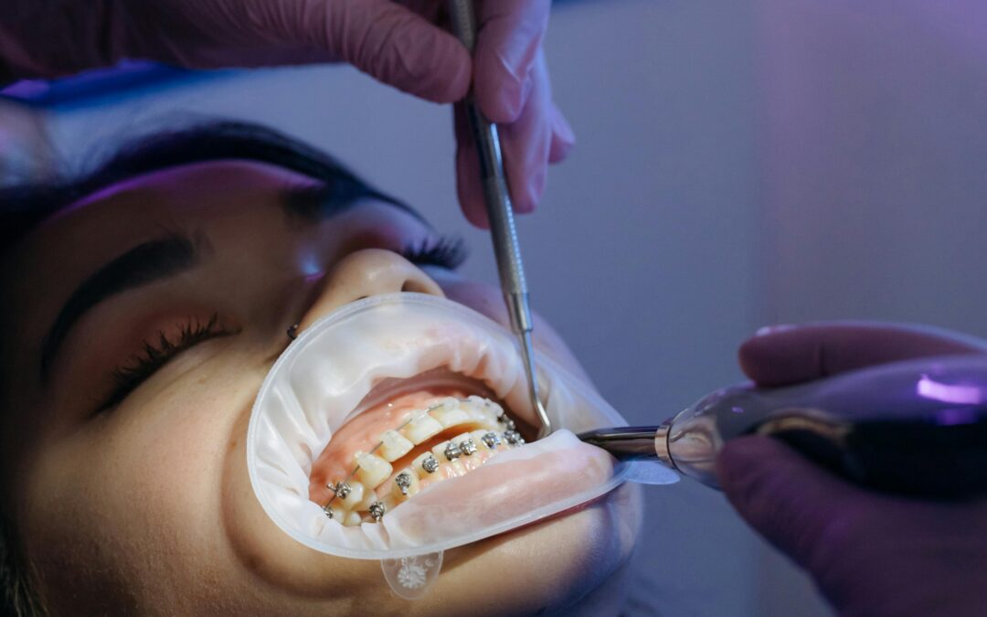 Types of Braces: Metal, Ceramic, Lingual, and Self-Ligating