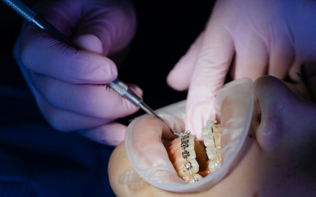 What Are Lingual Braces?