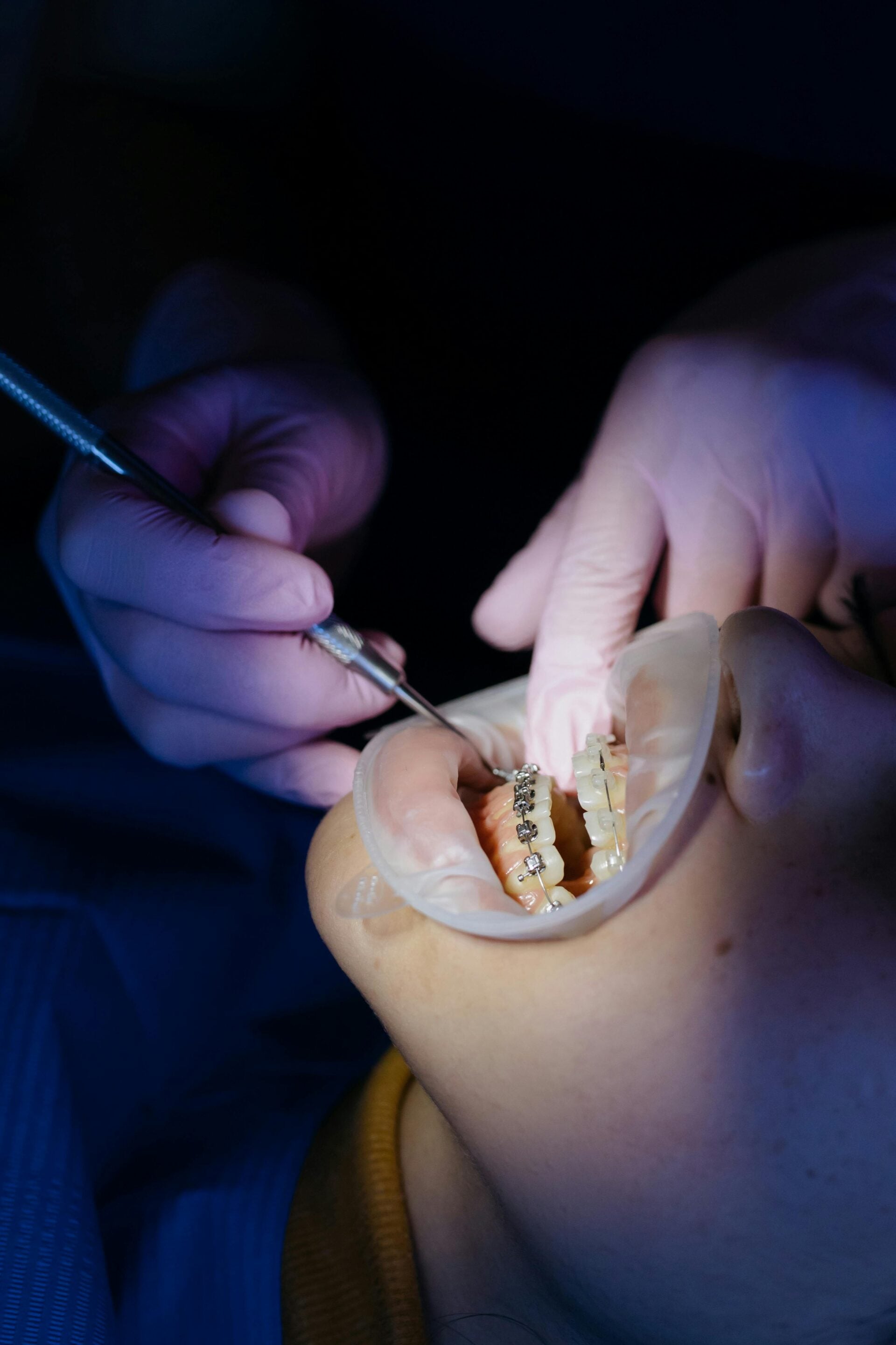 What Are Lingual Braces?
