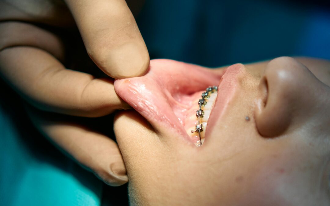 Self-Ligating Braces: Are They Faster?