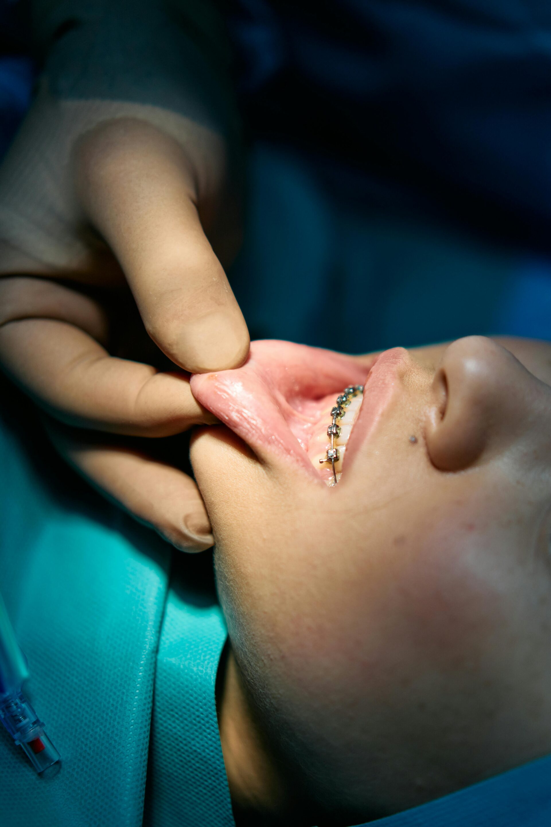 Self-Ligating Braces: Are They Faster?
