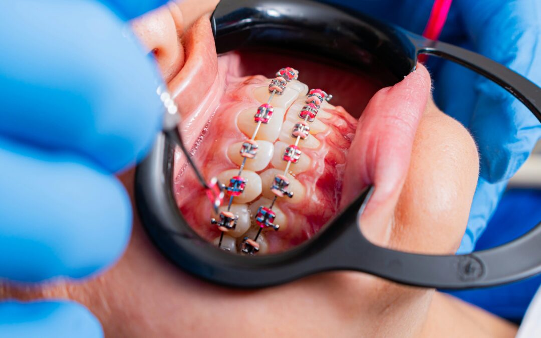 How Long Do Braces Take to Work?