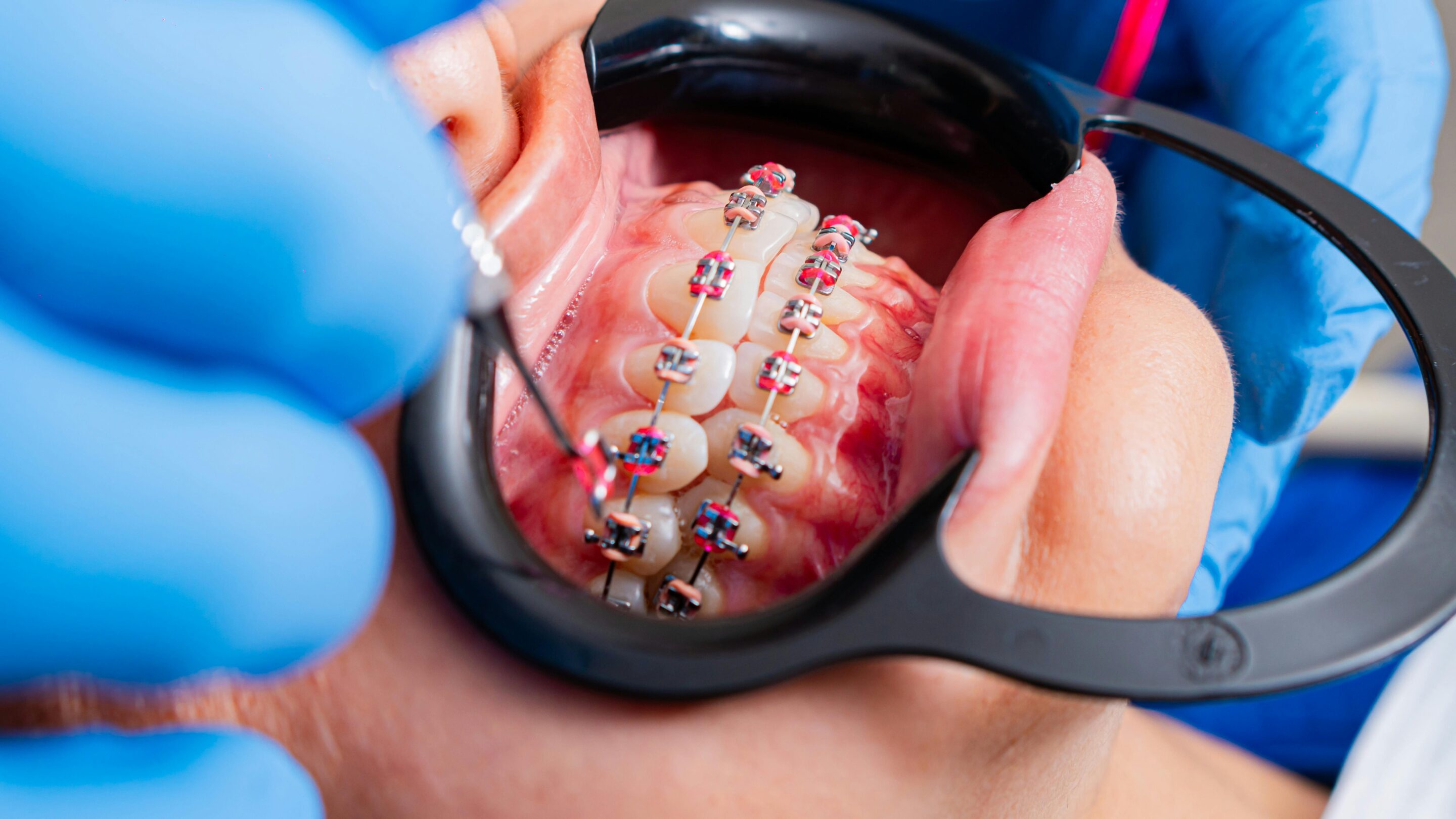 How Long Do Braces Take to Work?