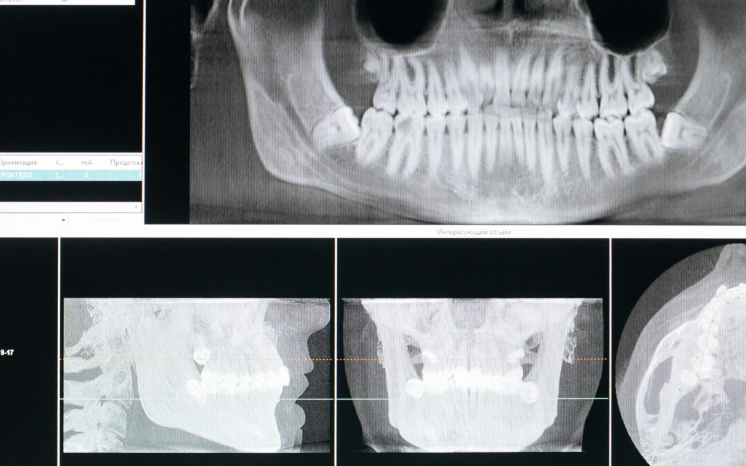 What Is an Abscessed Tooth?