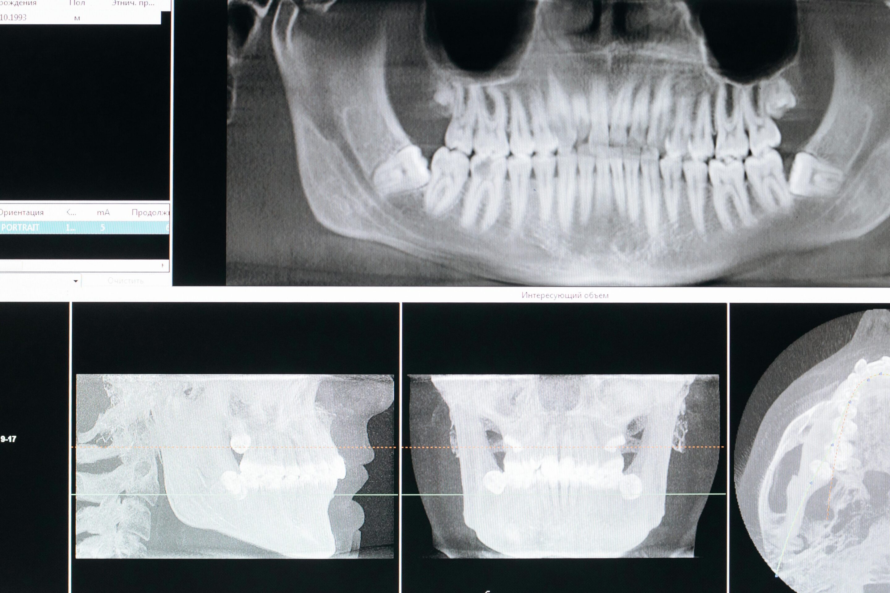 Panoramic dental x-ray on a monitor