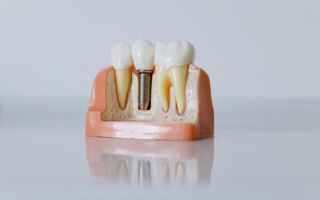 How Do Dental Implants Work?
