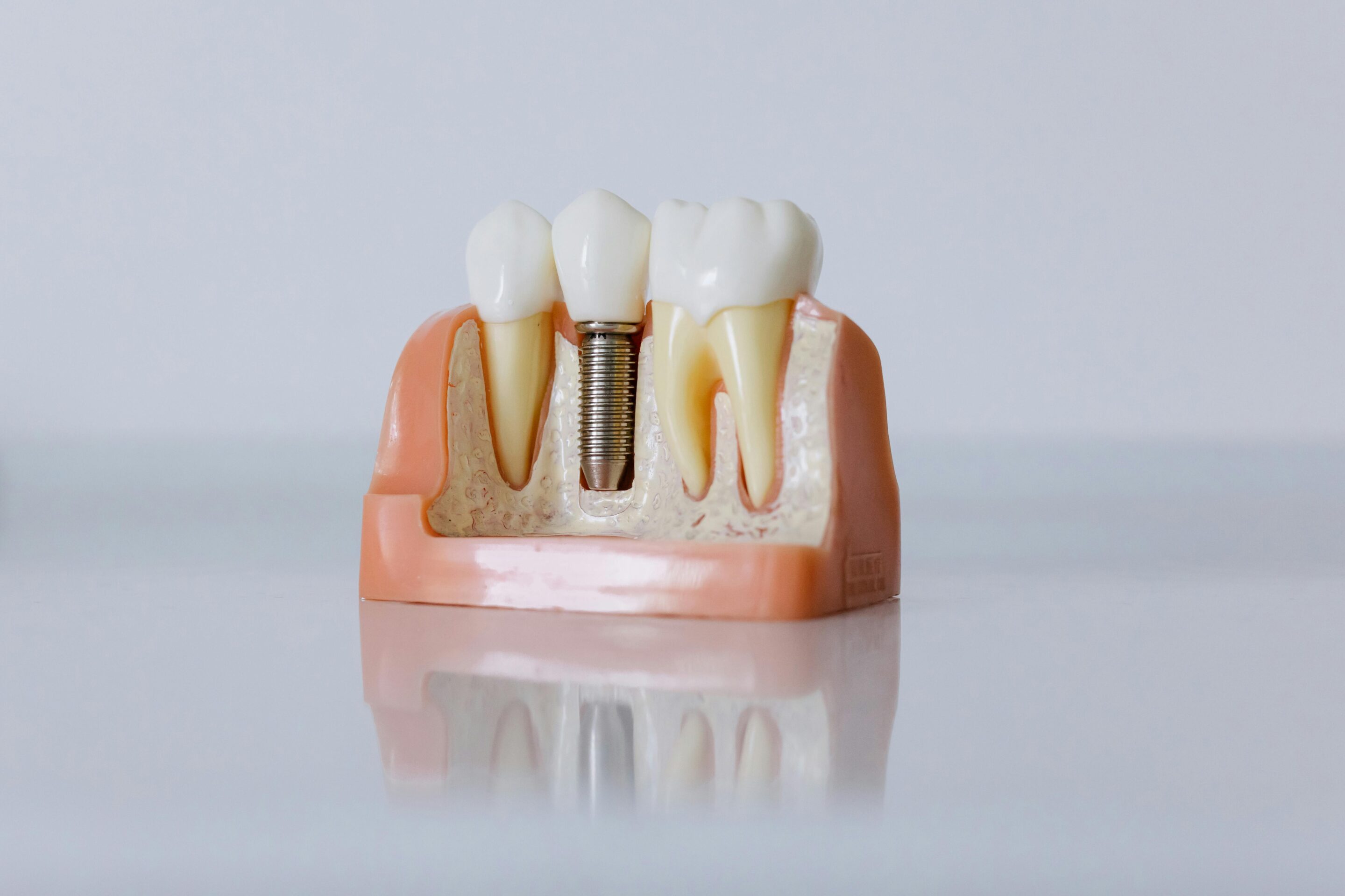 How Do Dental Implants Work? dental implants featured image