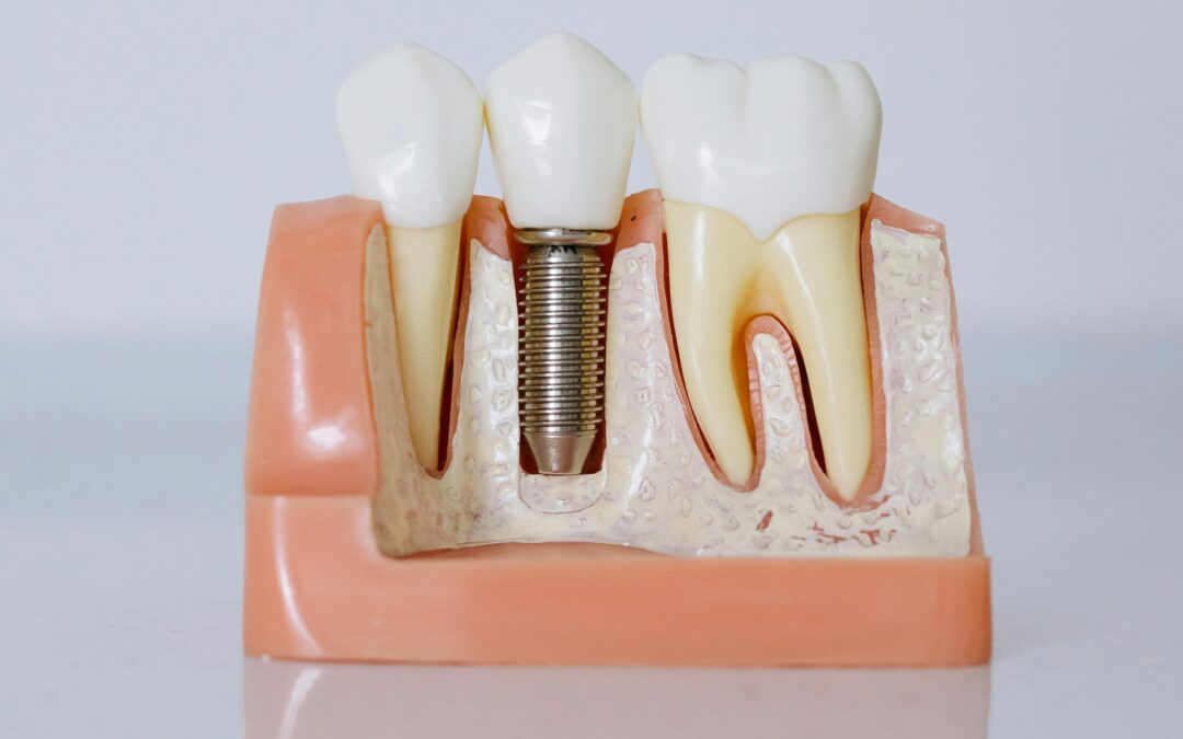 Parts of a Dental Implant: Implant, Abutment, and Crown Explained