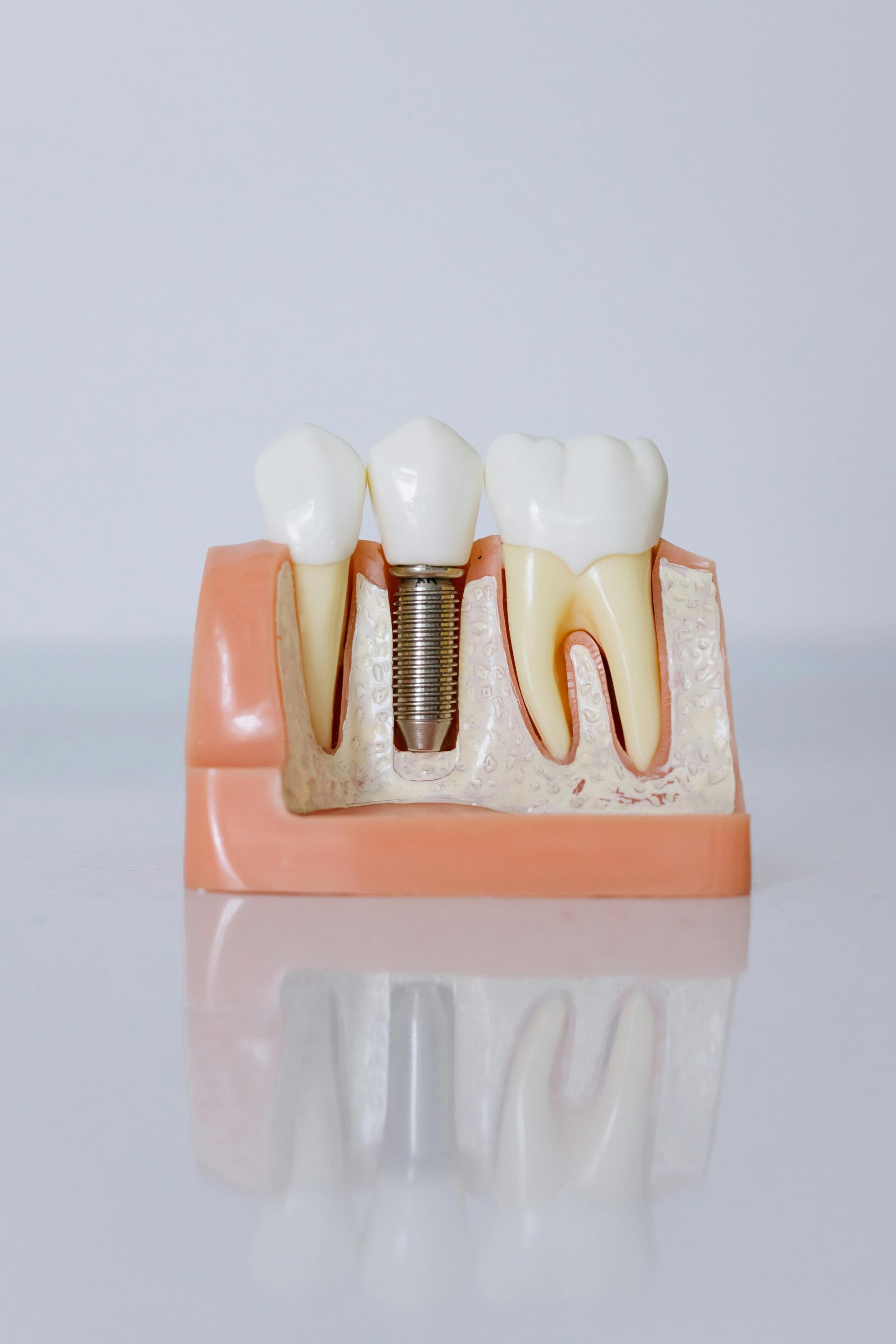 Parts of a Dental Implant: Implant, Abutment, and Crown Explained dental implants featured image