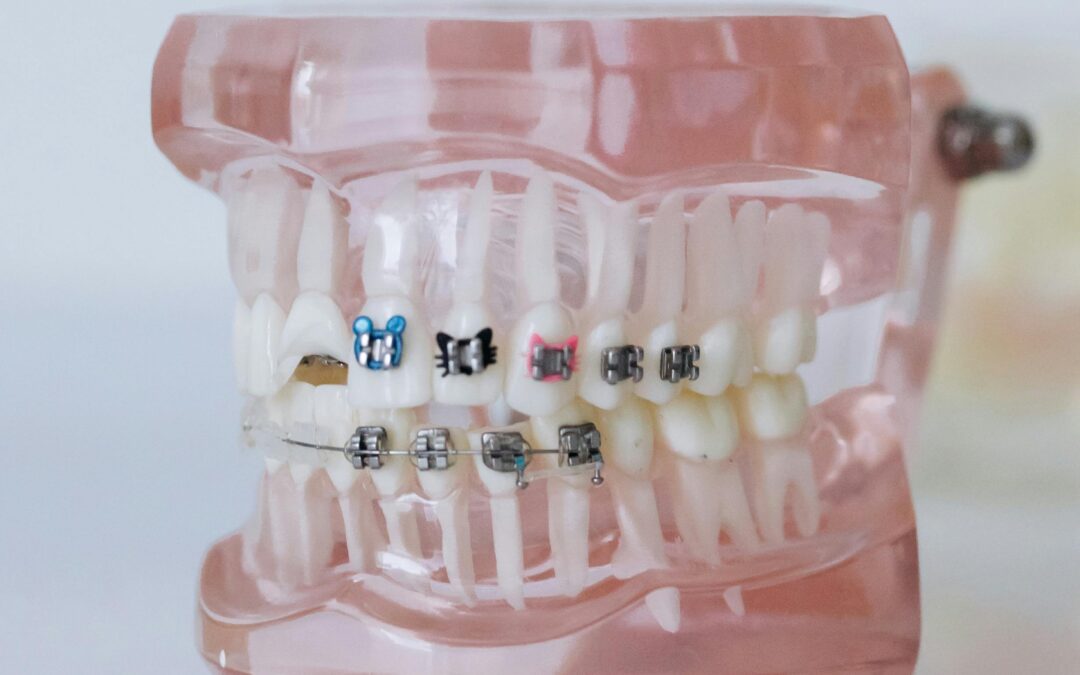 Can Invisalign Fix My Bite?