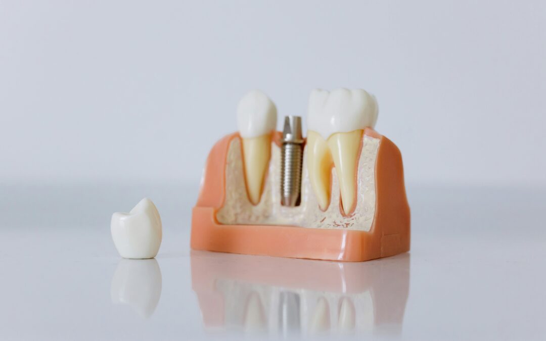 What Is a Dental Implant? The Complete Beginner’s Guide