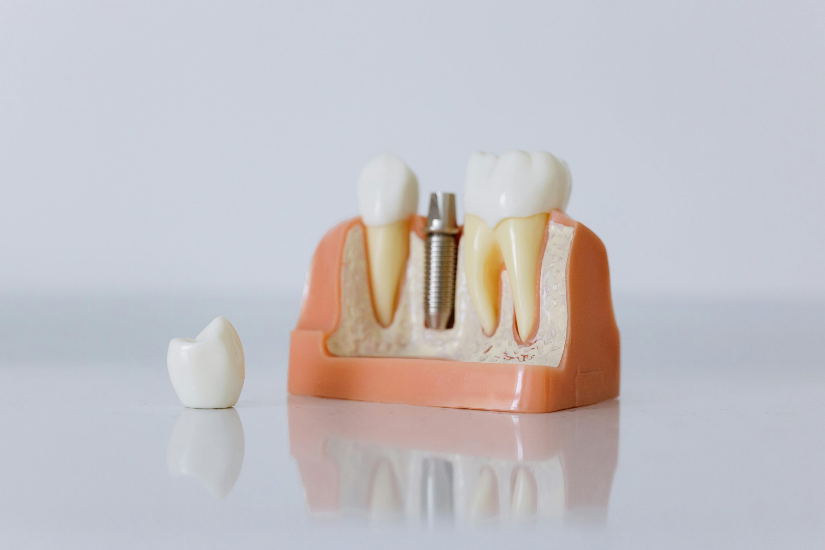 What Is a Dental Implant? The Complete Beginner's Guide dental implants featured image