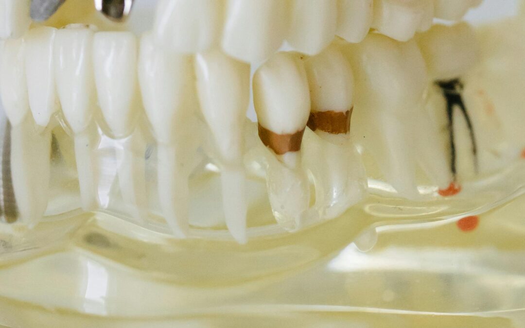 Dental Implant vs Denture: Which Is Better?
