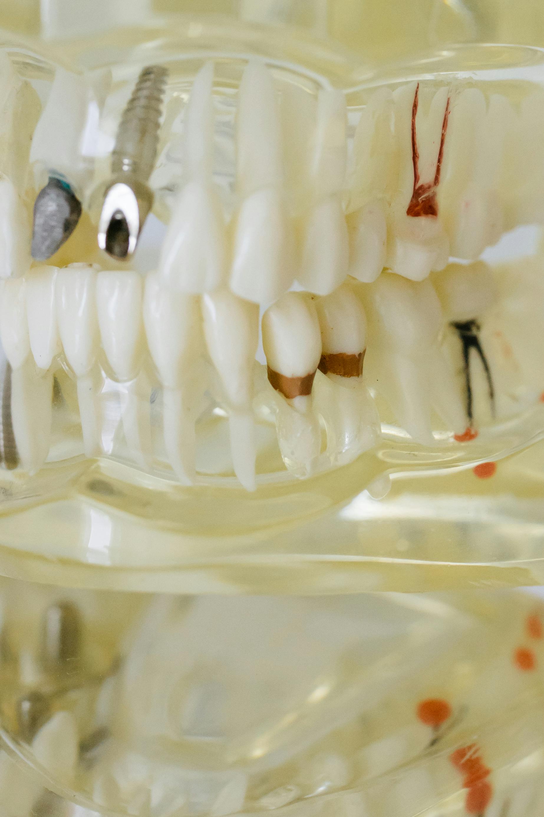 Dental Implant vs Denture: Which Is Better? dental implants featured image