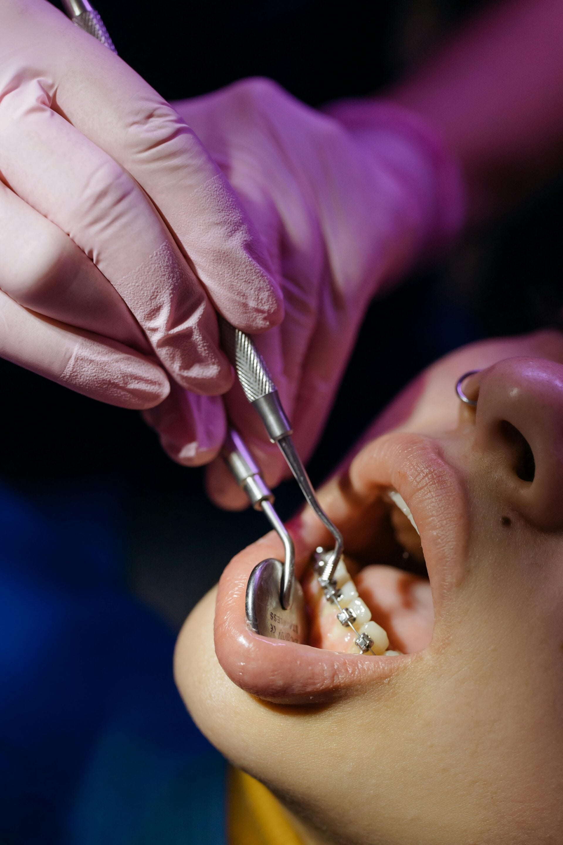 What Bite Problems Can Only Braces Fix?
