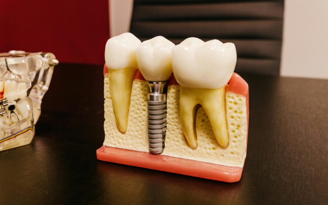 What Materials Are Dental Implants Made From?