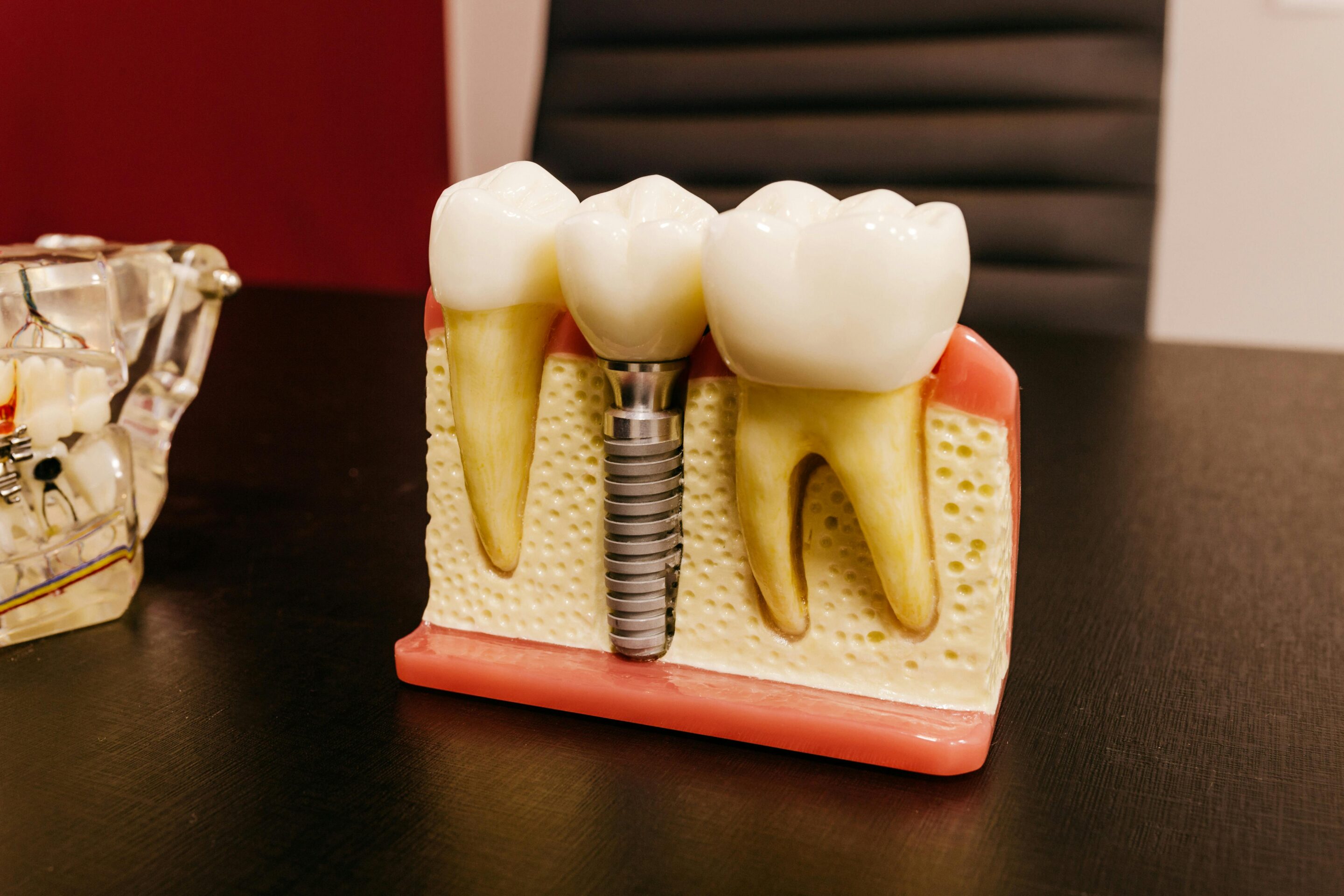 What Materials Are Dental Implants Made From? dental implants featured image