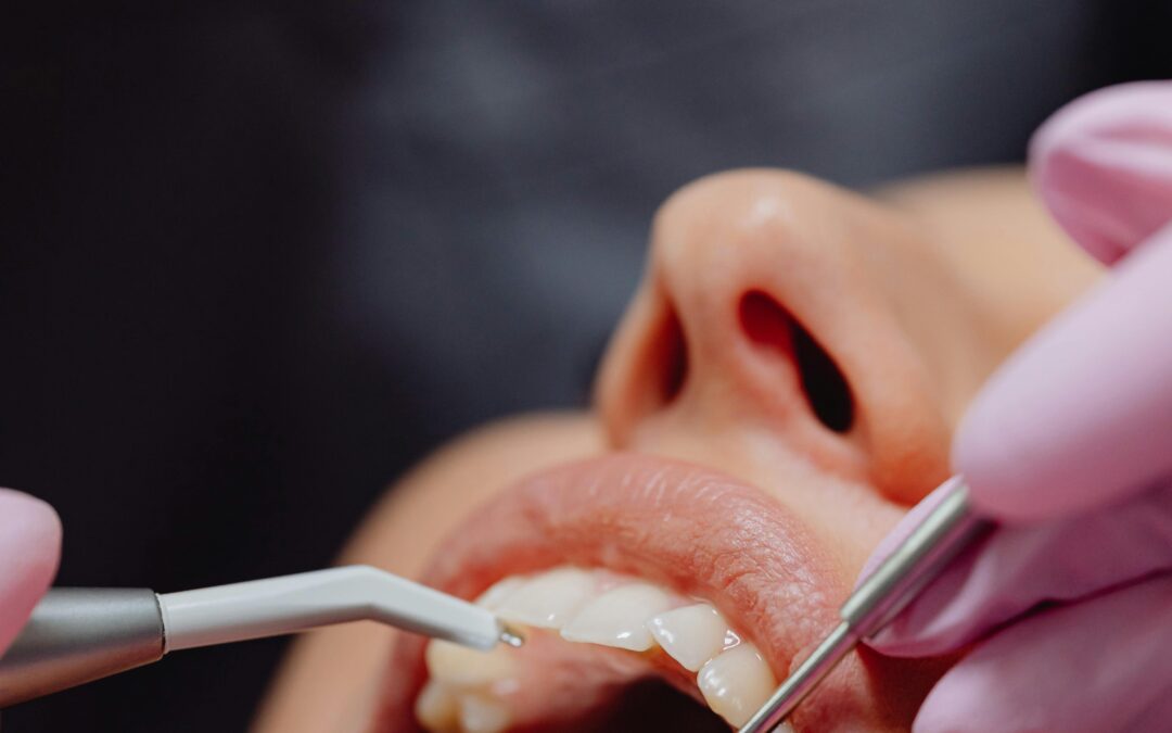 Stage 1 Periodontal Disease: What to Know