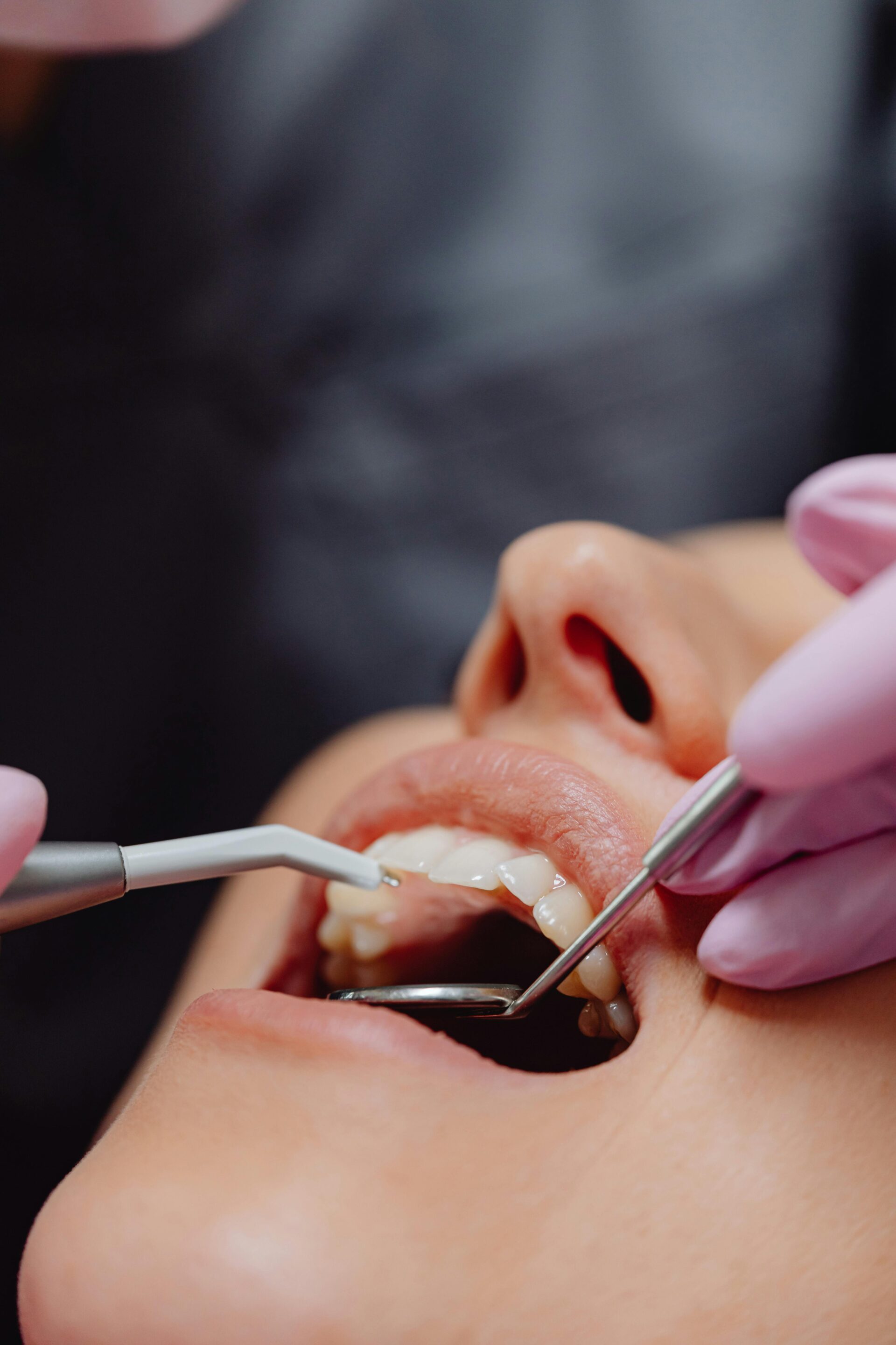 Close-up dental exam of upper teeth and gums