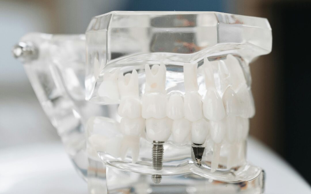 Dental Implant vs Dental Bridge: Complete Comparison