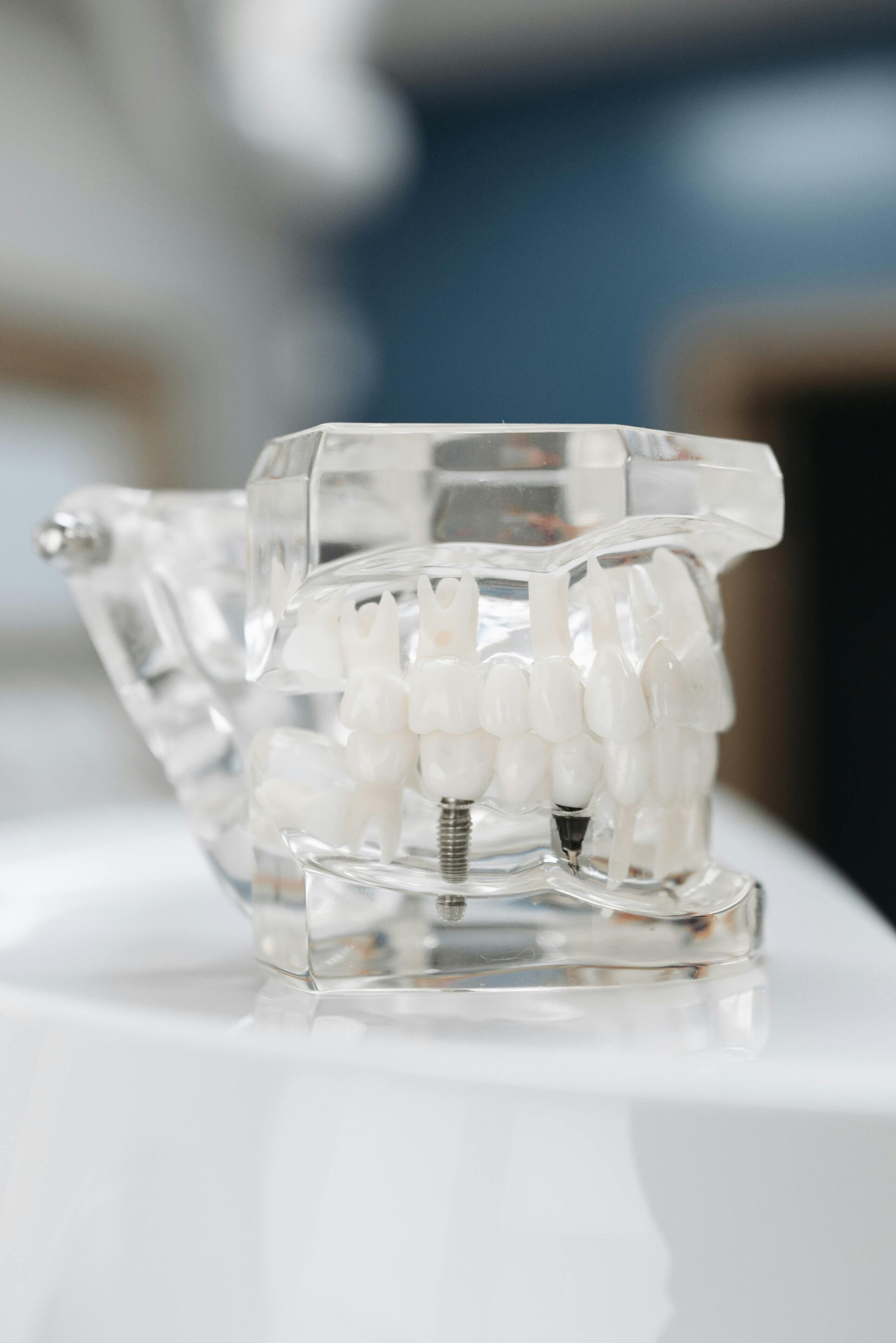 Dental Implant vs Dental Bridge: Complete Comparison dental implants featured image