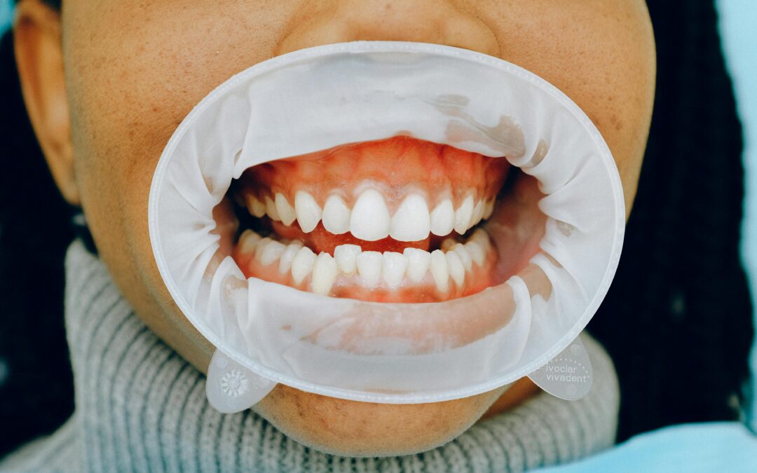What Is Periodontal Disease? A Complete Overview