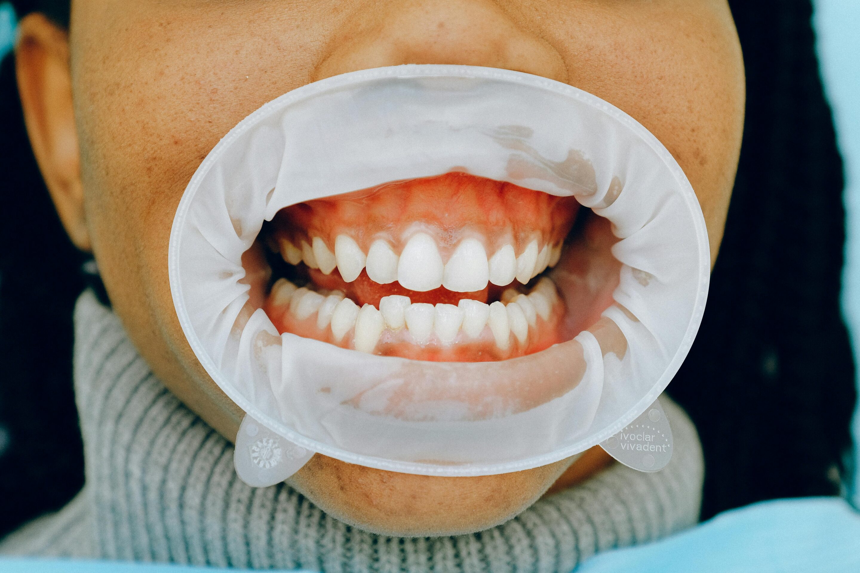 Open mouth dental checkup showing gums and teeth